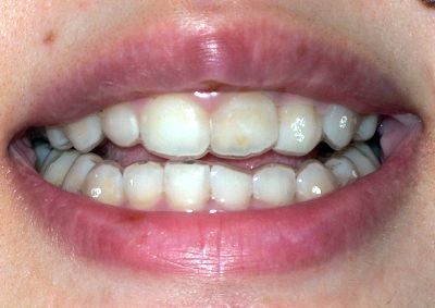 natural_teeth