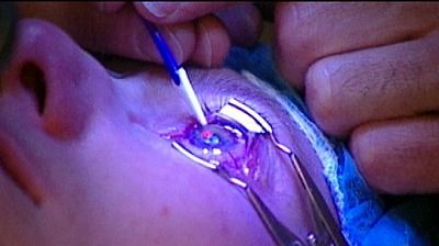 slive-lasik-surgery