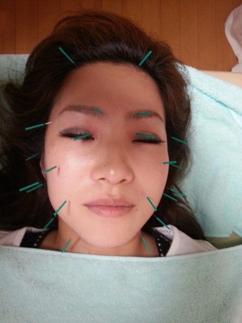 美容鍼20151022_8266