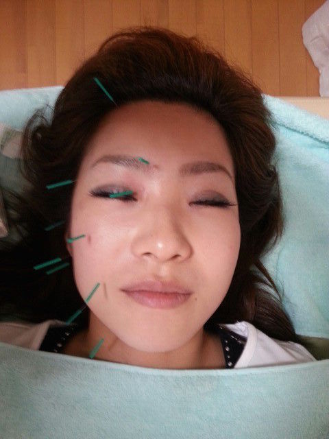 美容鍼20151022_2941