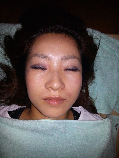 美容鍼20151022_4862
