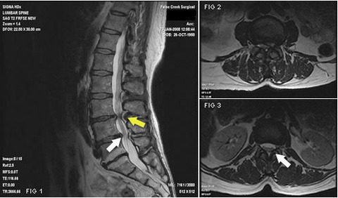 spinal_stenosis