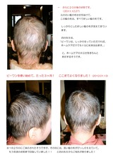 ３ヶ月で新しい髪の毛に・・（ｃｏｃｏ、ｍ）0002