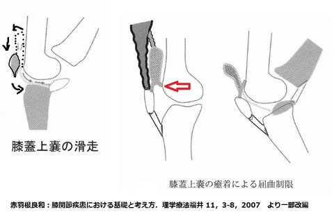 膝蓋上囊の癒着