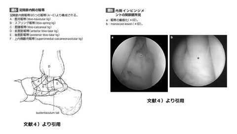 内側軟部組織インピンジメント