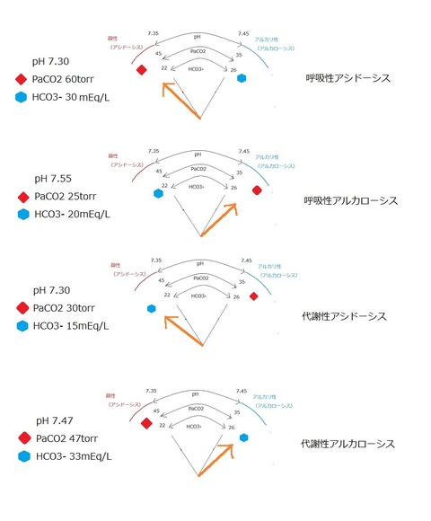 血液ガスの見方 -実際