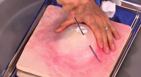 1414586581313_wps_70_how_to_pop_a_pimple_dr_oz-e1414594694457