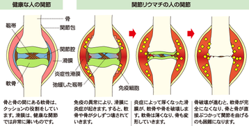 関節リウマチ 画像1