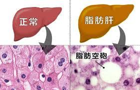 脂肪肝 画像1