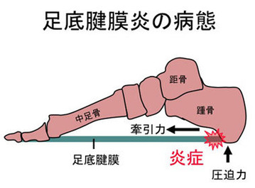 足底筋膜炎 画像1