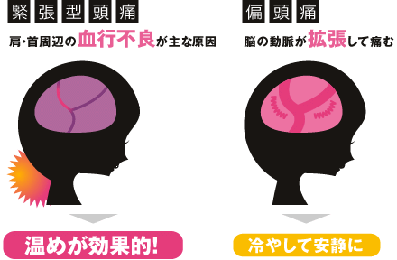 頭痛の特徴 画像1