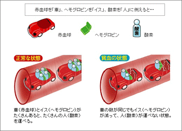 貧血の例え 画像1