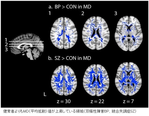 white matter change-11
