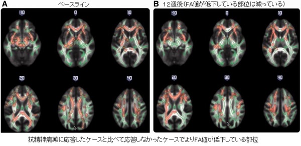 white matter change-9