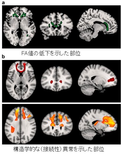 white matter change-3