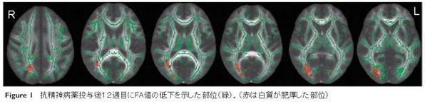 white matter change-5