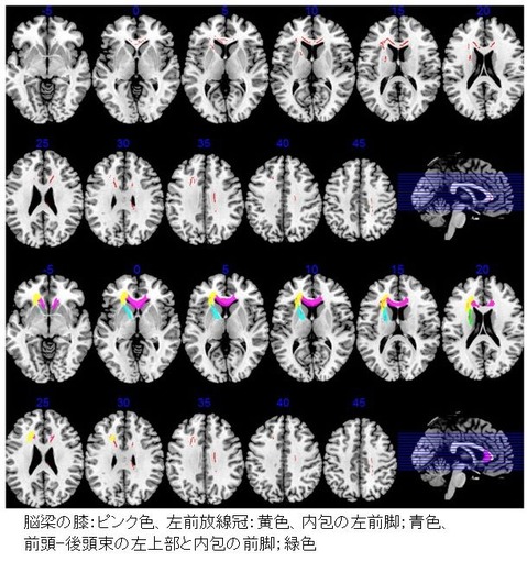 white matter change-15