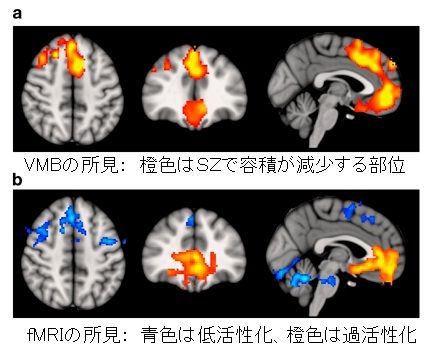 white matter change-2