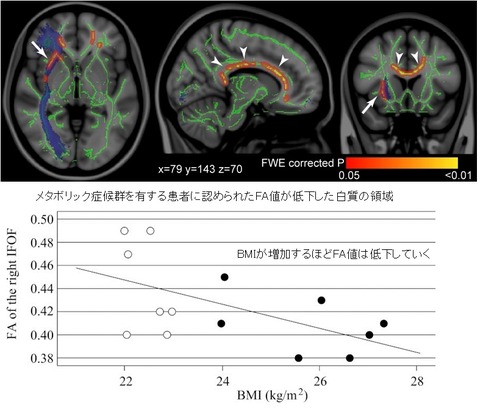 white matter change-17