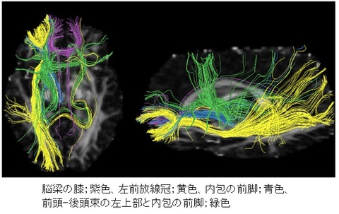 white matter change-16