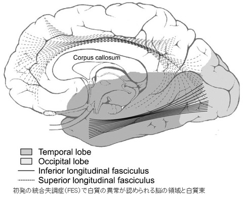 white matter change-1