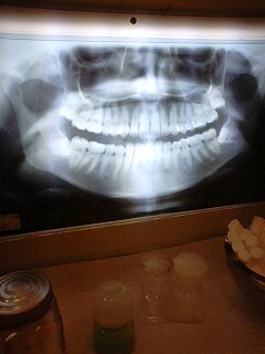 親知らず レントゲン 写真 画像