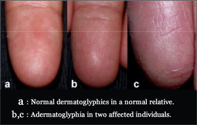 adermatoglyphia-no-fingerprints