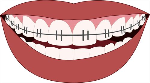 orthodontics-3109763_1280_R