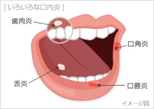 口内炎とかいう人類最大の敵wwwwwwwwww