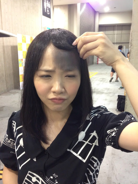 【悲報】SKE48松村香織の地毛が2箇所かさぶたごと抜ける