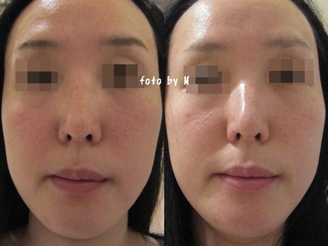 Tbc 毛穴エステ フェイシャルコース 体験3000円 5000円に行った感想 キャビテーション 体験 はしごした口コミ ビフォーアフター写真あり