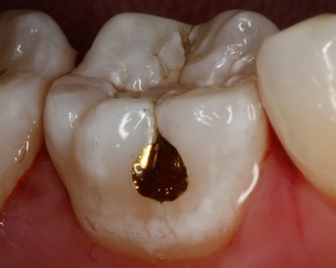 goldfoil