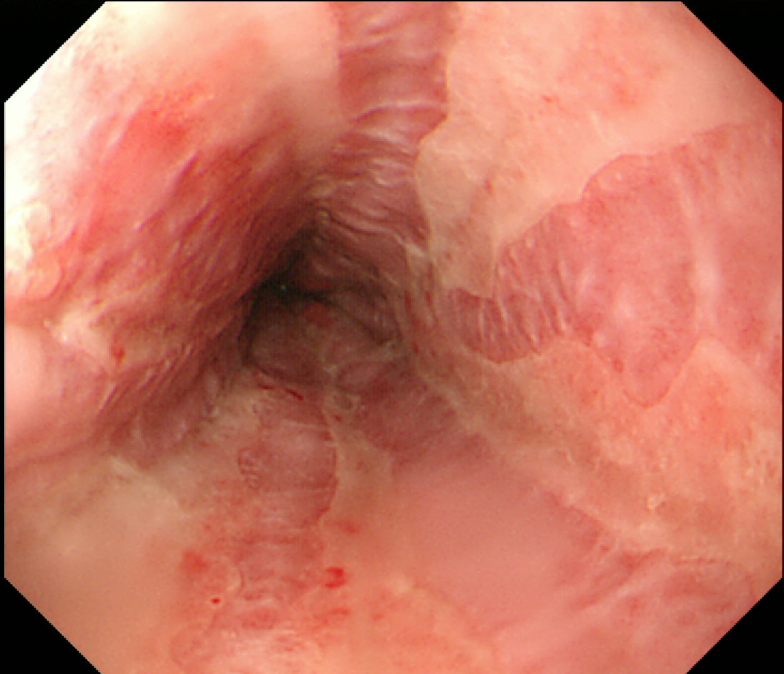 mucous membrane pemphigoid