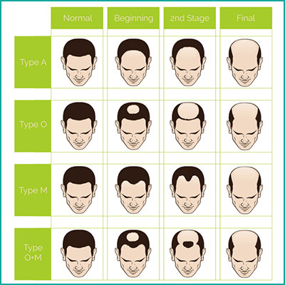 loss-hair-chart-1