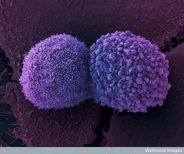 がん細胞６