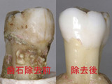歯石