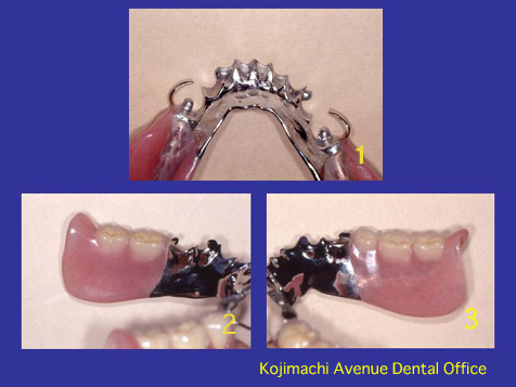 denturekaisetu