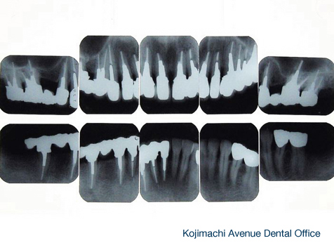 final X-ray