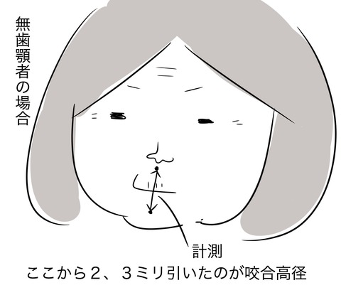 咬合採得2