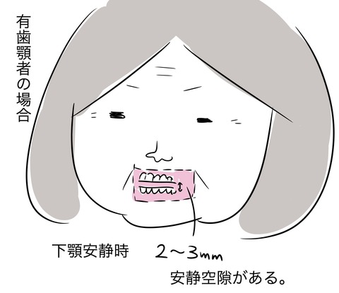 咬合採得1