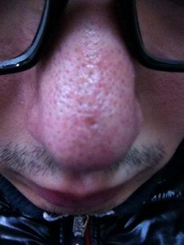 いちご鼻