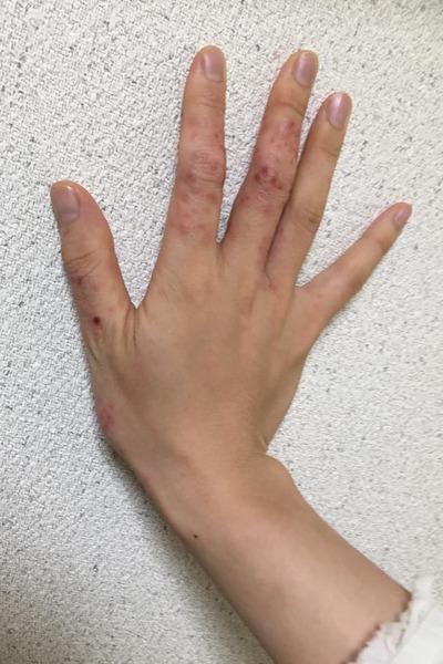 アトピーの手