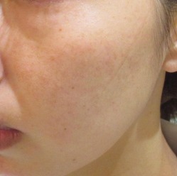 スタッフのシミ治療 経過写真 Dr Fumiの美容blog