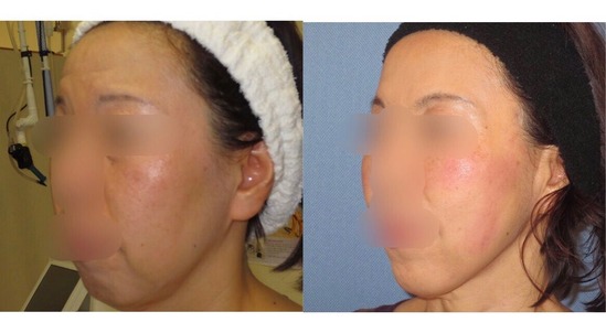 TFTの効果(ヒアルロン酸とボトックス、リフトアップ糸で)