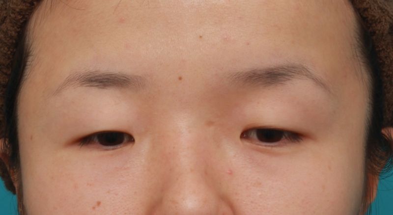 昨日アップした、眼球自体が小さい目に対して、目頭切開+眼瞼下垂手術をした症例写真の解説です。