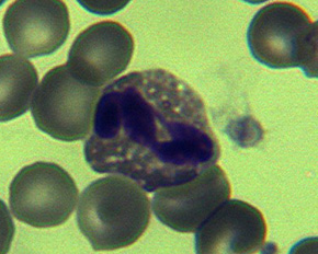 ������ʤ������󤭤夦��Eosinophil�������ʴݤ���γ�򤿤�������ĺ�˦��