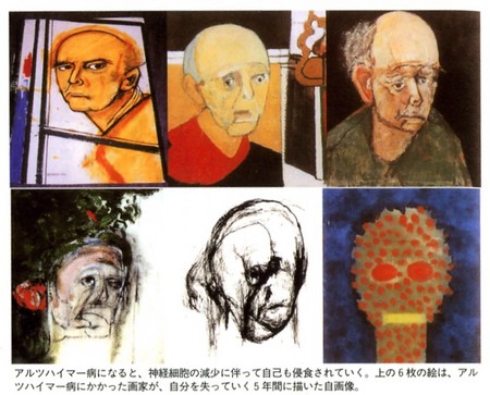 アルツハイマー病、自画像