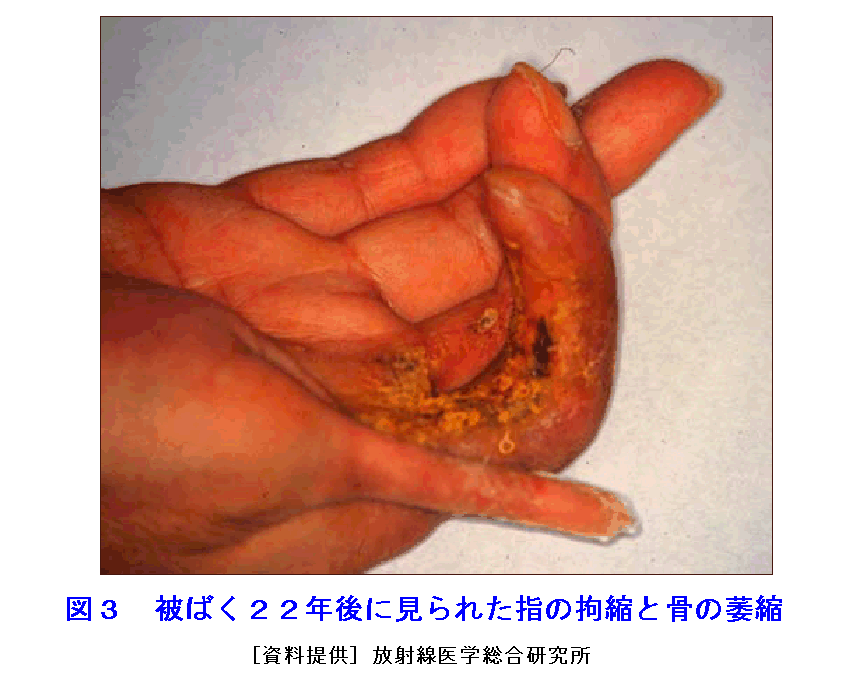 被爆その後