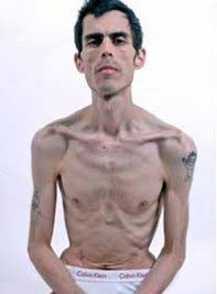 拒食症男