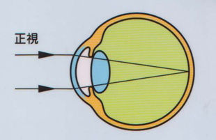 ピント 合わ ない 片目 が だけ